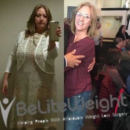 Weight Loss Surgery Before And After